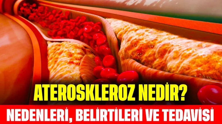 Ateroskleroz Nedir? Nedenleri, Belirtileri ve Tedavisi